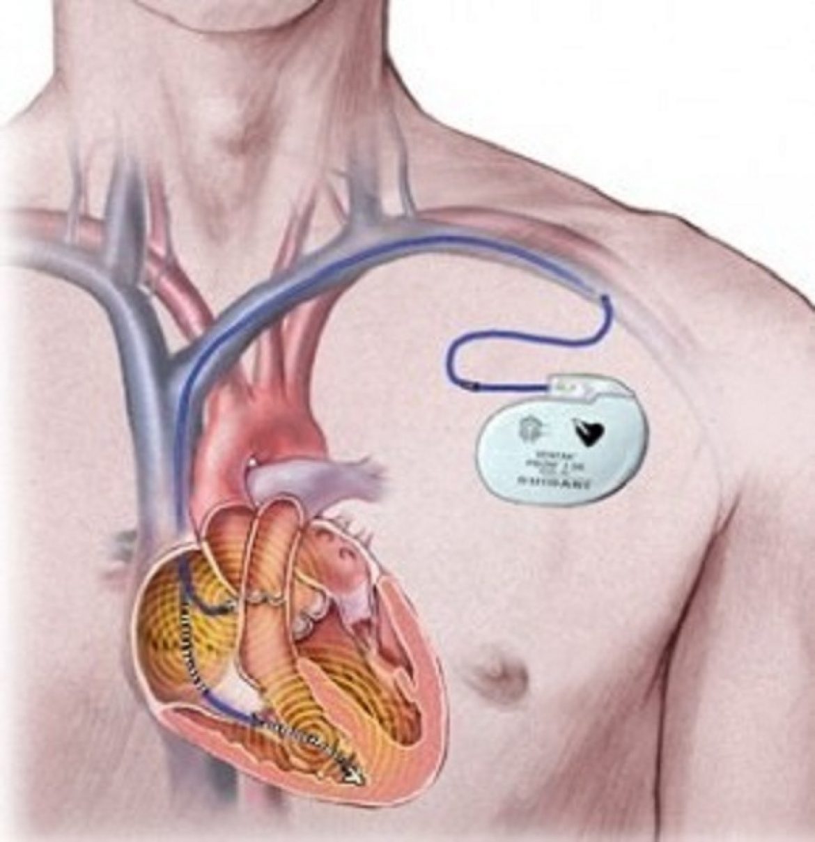 Сколько живут с кардиостимулятором. Кардиостимулятор сердца. Кардиостимулятор брадикардия. Имплантируемый кардиовертер-дефибриллятор. Кардиостимулятор сердца имплантируемый.